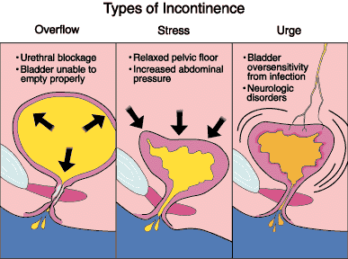 UrinaryIncontinence