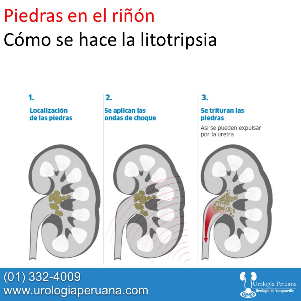 litrotripsia-extracorporea-calculos-renales-gratis