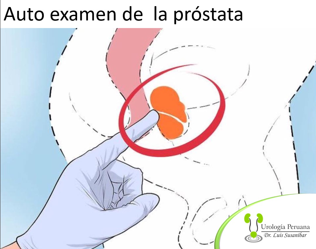 auto xamn prostata peru