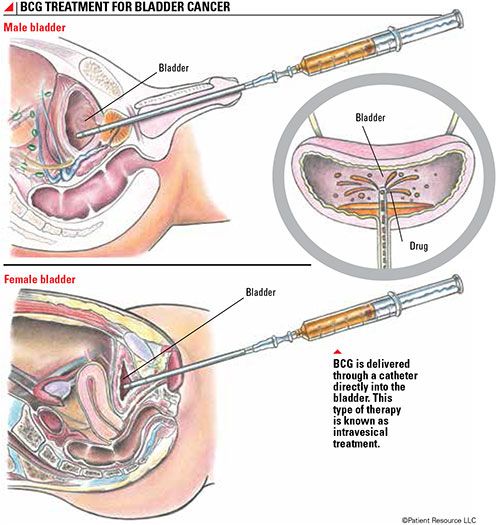 INSTILACION VESICAL PERU UROLOGO