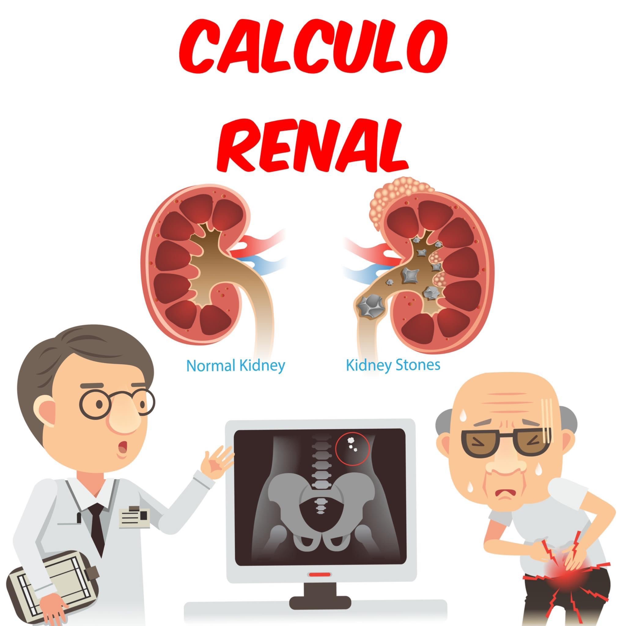 Cálculo renal revisitado – Urología Peruana. Dr. Susaníbar