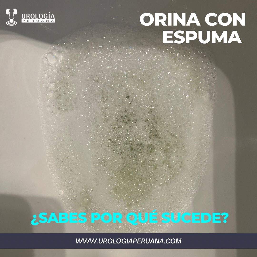 Orina Espumosa Y Proteinuria : ¿Orinar con espuma es malo? – GQUGX