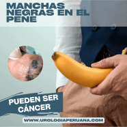 Melanoma Del Pene C ncer De Pene 12 S ntomas Causas Y Tratamiento Melanoma Del Pene C ncer De Pene 12 S ntomas Causas Y Tratamiento