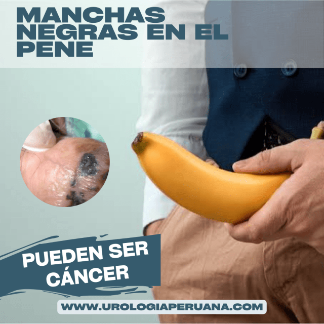 macula melanotica en el glande labial Mcula melantica labial - Hoogstra