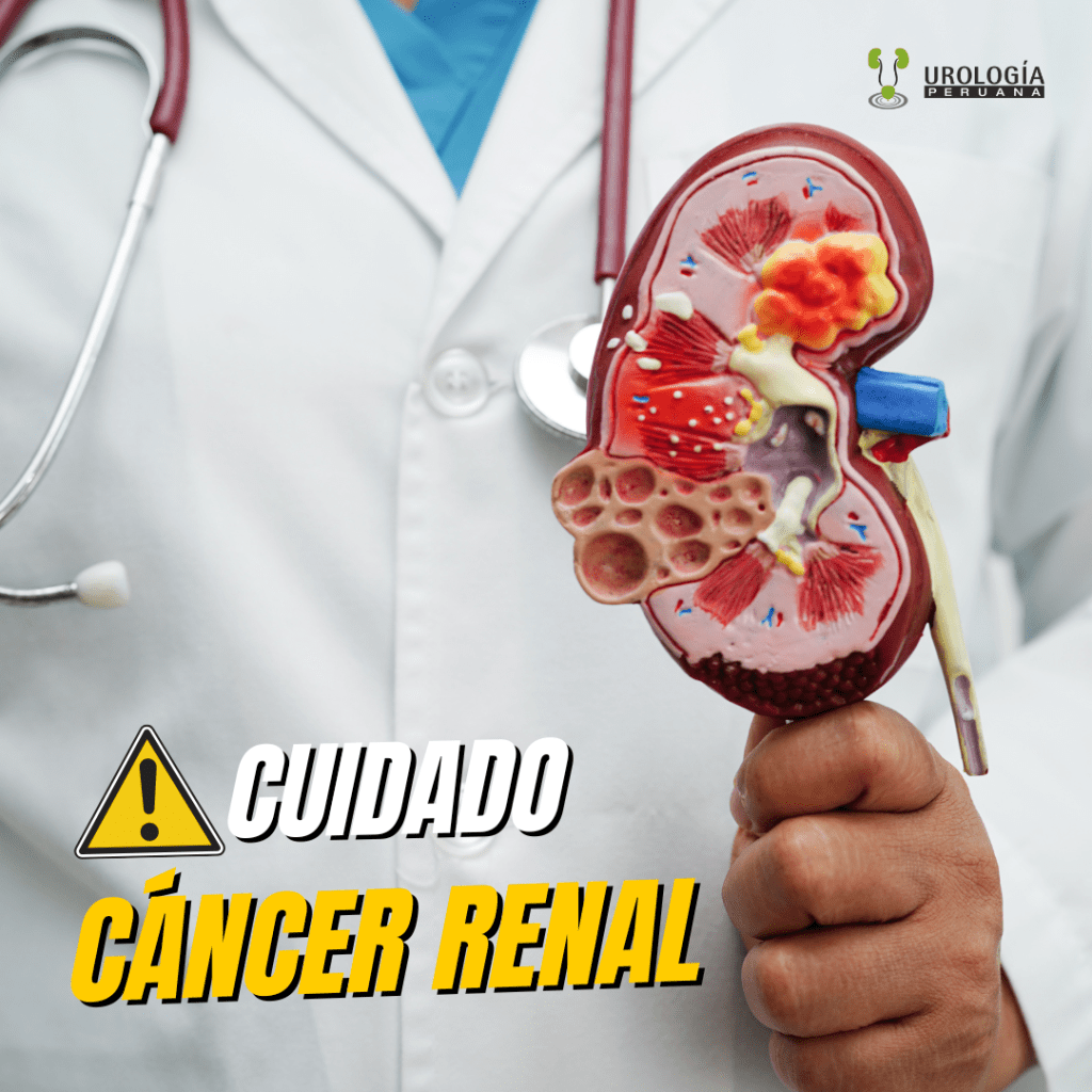 Tratamiento del Cáncer de Riñón: Un Enfoque&nbsp;Actualizado