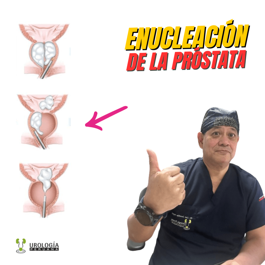 Vídeos sobre enucleación láser en&nbsp;bloque.