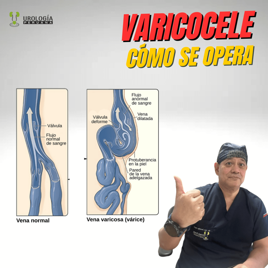 ¿Cómo se opera el&nbsp;varicocele?