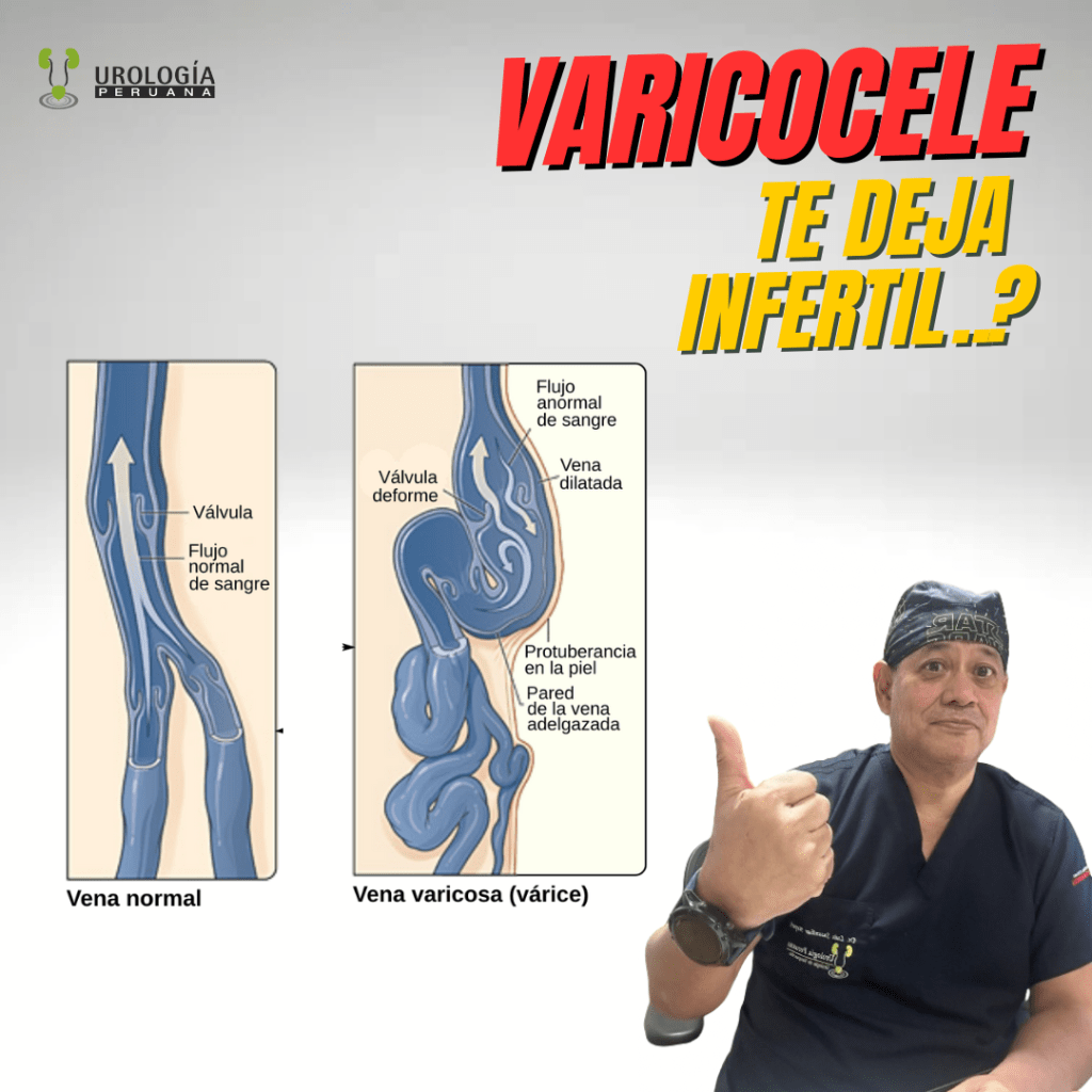 ⚠️ ¿Tener varicocele hace que siempre tengas&nbsp;infertilidad?