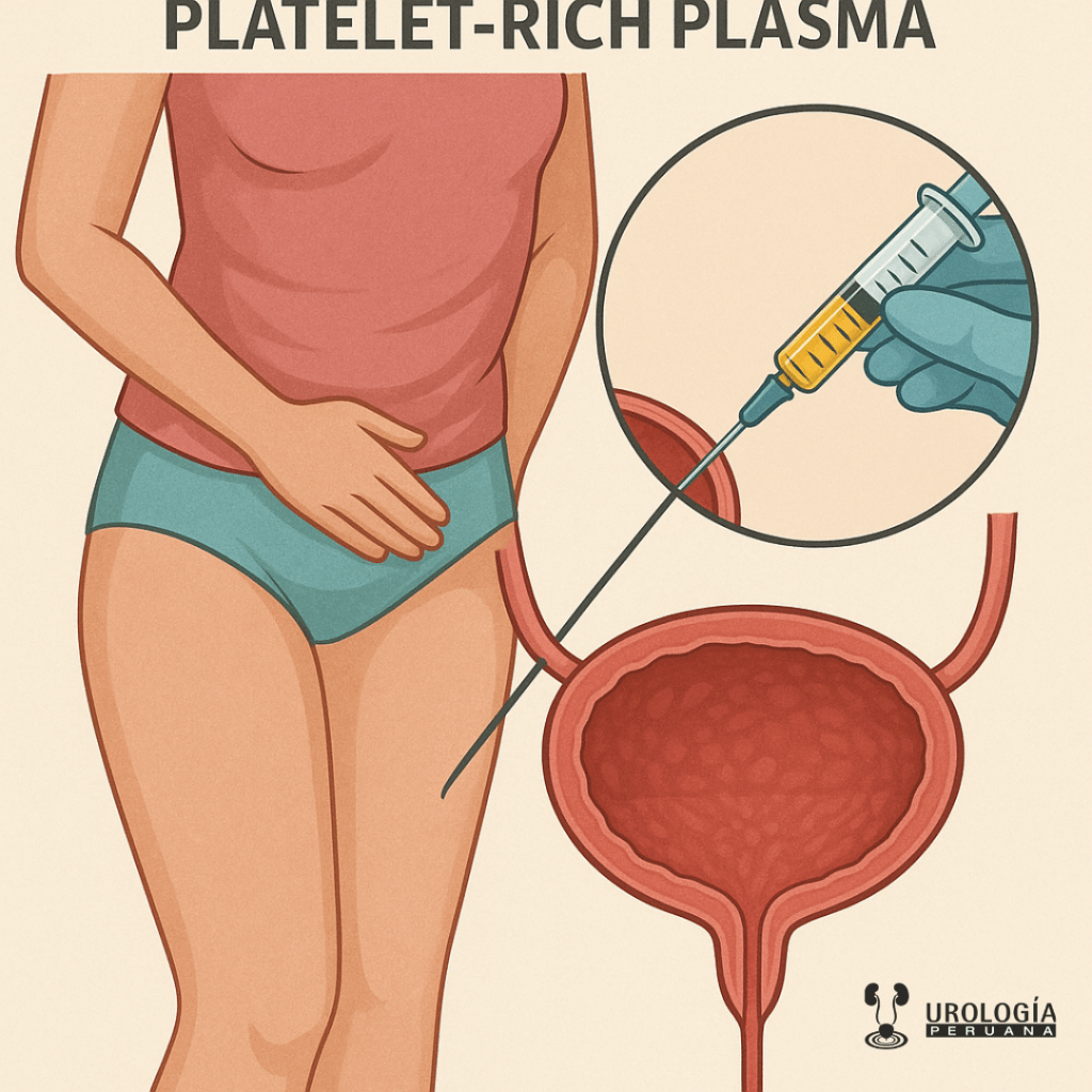 Nuevo tratamiento para la cistitis intersticial: plasma rico en&nbsp;plaquetas