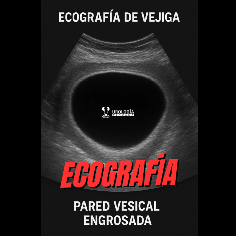 Cuando hablamos de una pared vesical&nbsp;engrosada