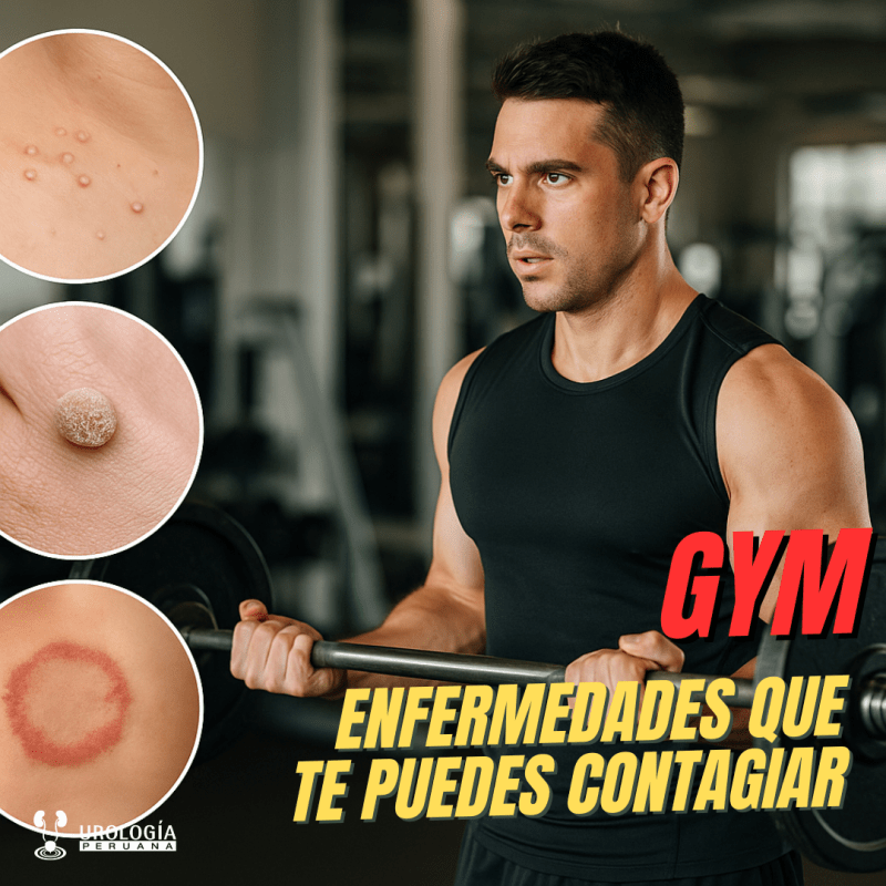 Enfermedades e infecciones que pueden contraerse en el&nbsp;gimnasio