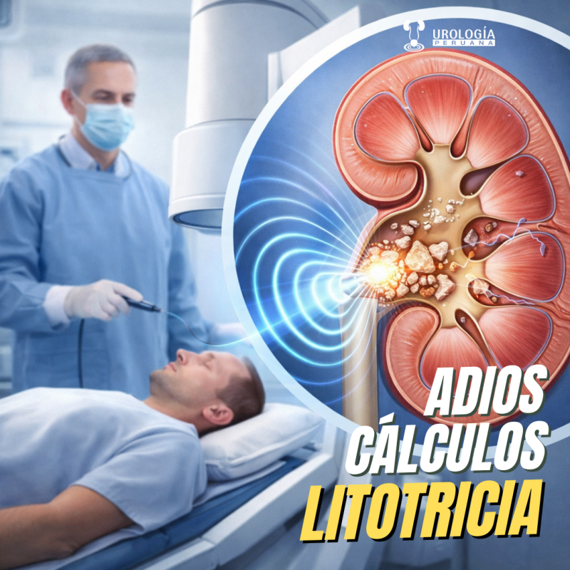 Litotricia extracorpórea por ondas de choque: ¿sigue&nbsp;vigente?