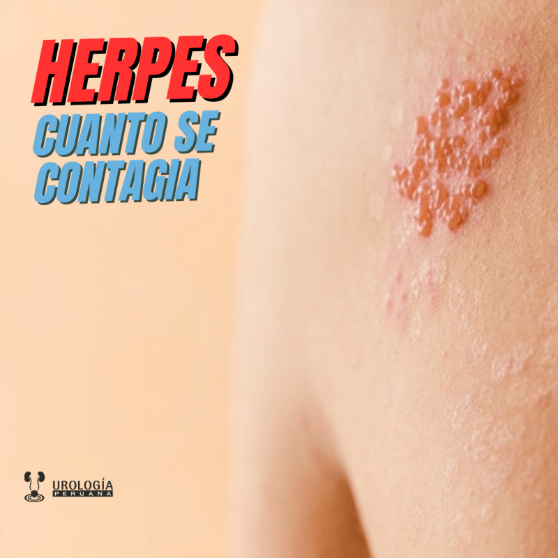 Herpes genital: qué tan rápido se contagia y de qué&nbsp;depende