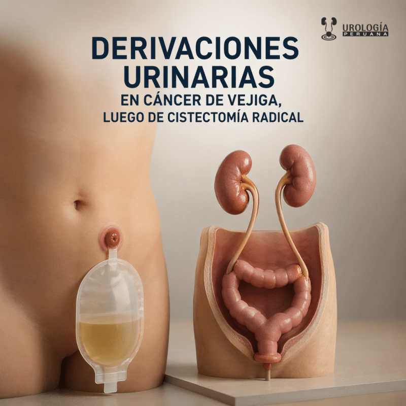 Derivación urinaria tras cistectomía en cáncer de&nbsp;vejiga
